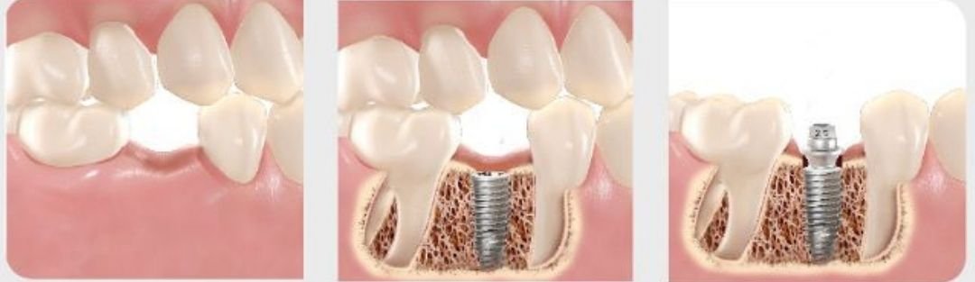Implantes Dentários em Lavras