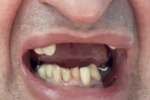 Implantes Dentários em Lavras