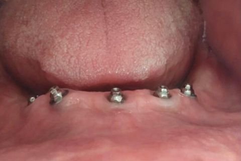 Implantes Dentários em Lavras