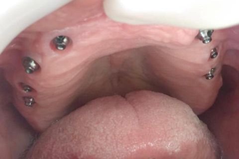 Implantes Dentários em Lavras