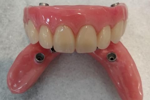 Implantes Dentários em Lavras