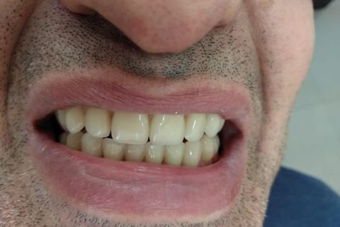 Implantes Dentários em Lavras