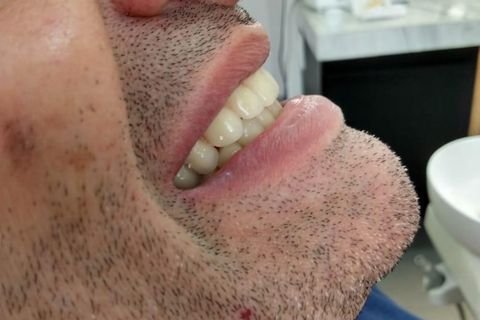Implantes Dentários em Lavras